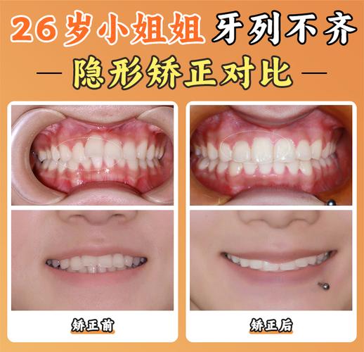 深圳北京舌侧矫正靠谱吗?价格/医院/医生全揭秘