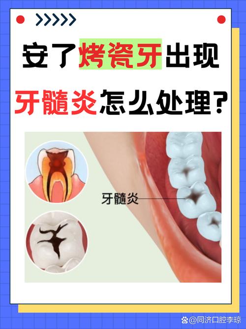 深圳牙医良心忠告:做烤瓷牙前这两点不注意,当心毁了整口牙