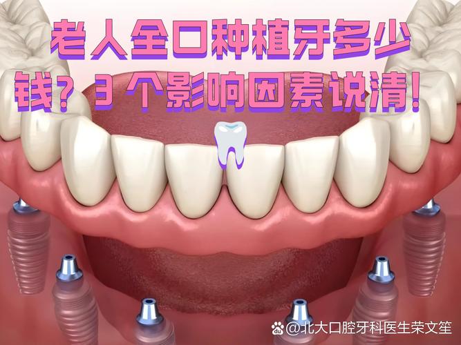 深圳老人全口种牙费用明细 深圳全口种植牙价格参考