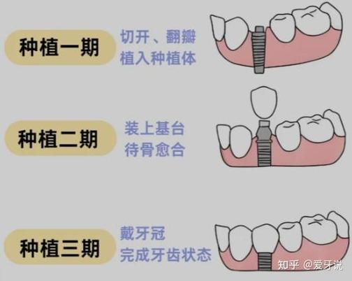 深圳杭州种植牙骨粉贵不贵?要补多少?