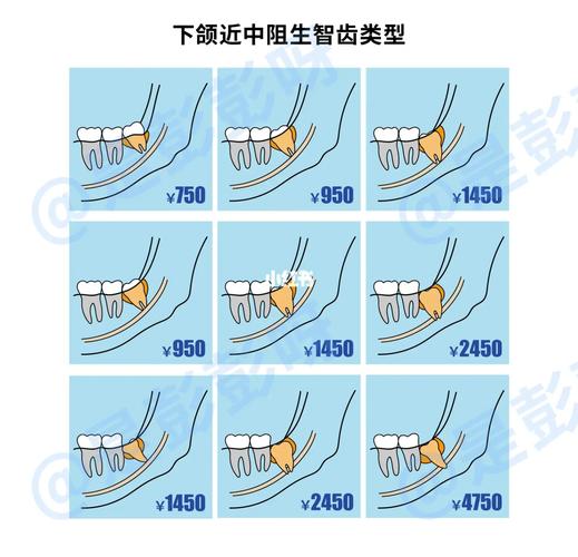 深圳杭州口腔医院拔牙要花多少钱?怎么选才不踩坑?