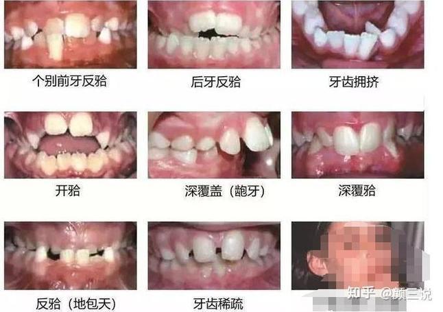 深圳青岛儿童几岁做正畸最好?多少钱?