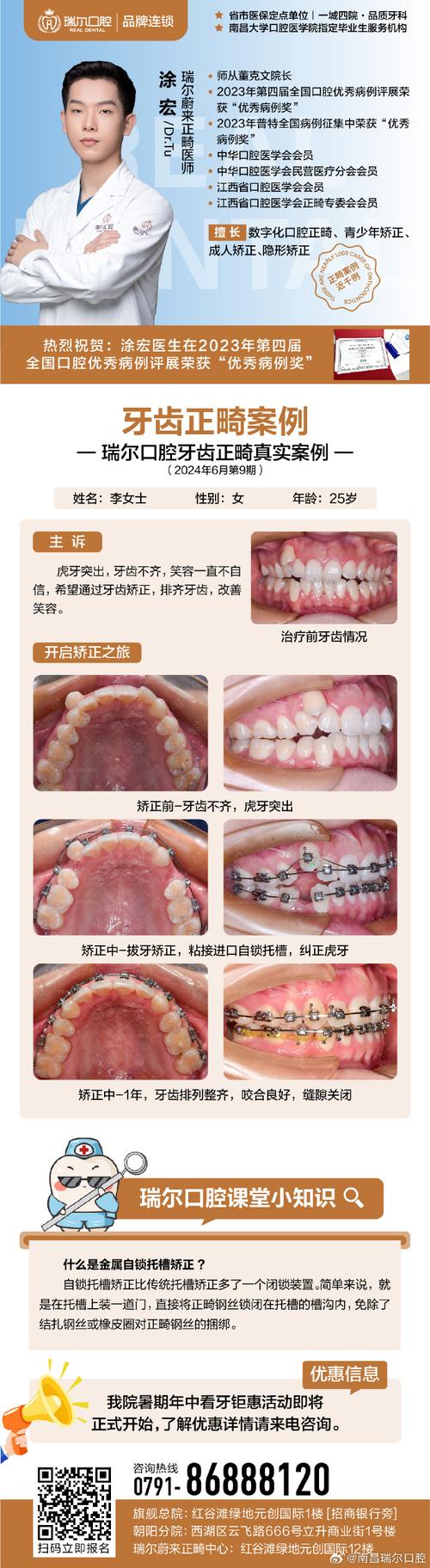 深圳成人龅牙矫正选医院还是诊所?关键看医生资质和案例对比