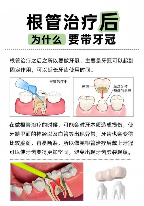 深圳根管治疗补牙到底怎么回事?医生详解步骤和必要性
