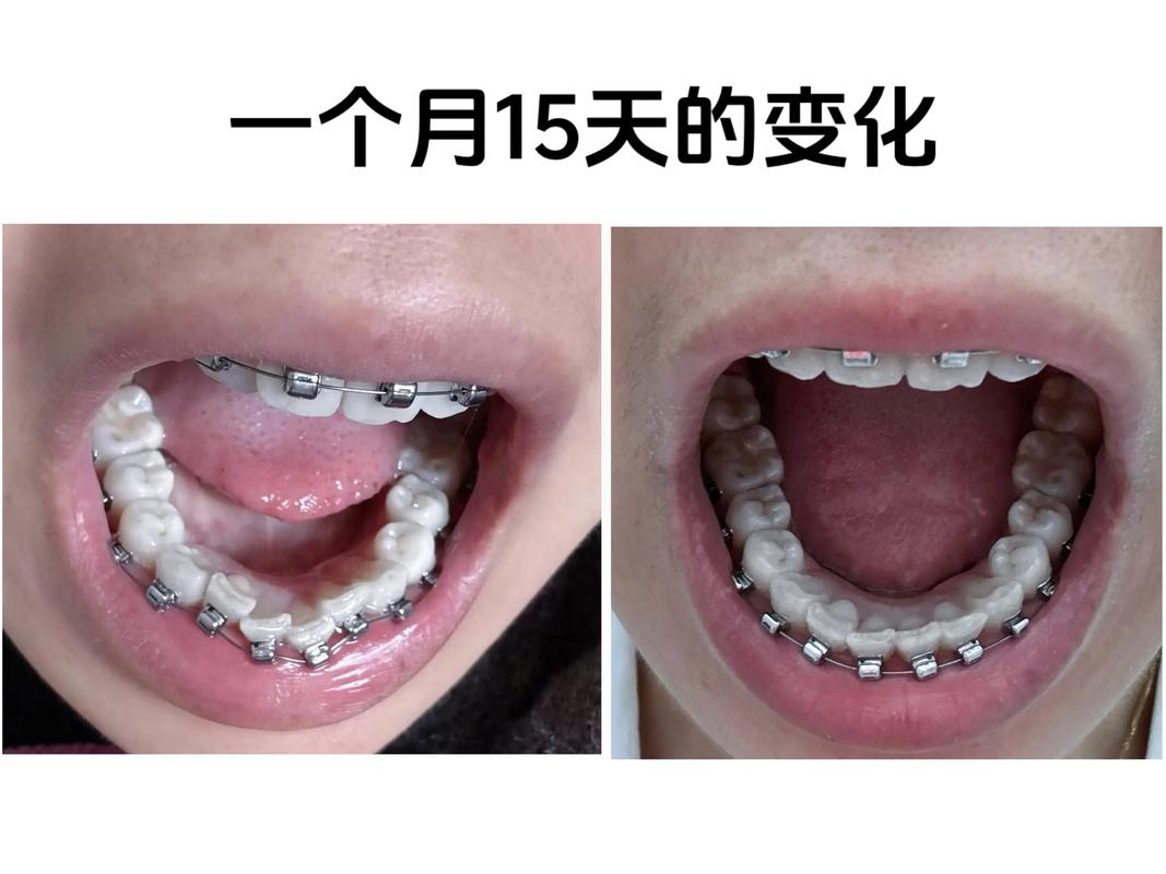 深圳50岁还能矫正牙齿吗?中年正畸真实效果与风险解析