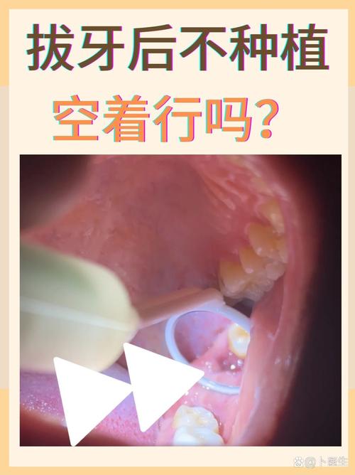 深圳成人拔牙后必须种牙吗？不种牙的后果，医生告诉你真相