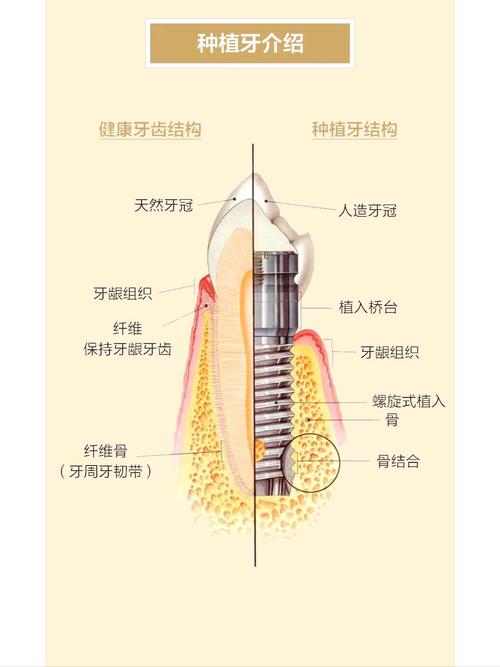 深圳什么叫种植牙齿 一篇讲清原理过程