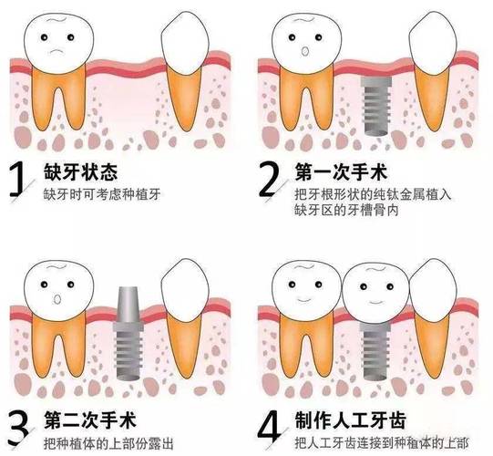 深圳上海种植牙全过程揭秘:从挂号到戴牙多久?