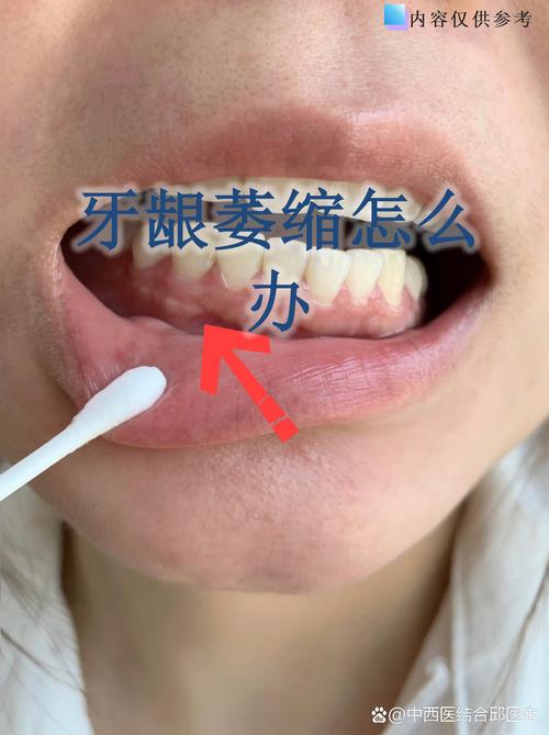 深圳缺牙不补的严重后果:邻牙倾斜松动,对牙伸长,牙槽骨萎缩