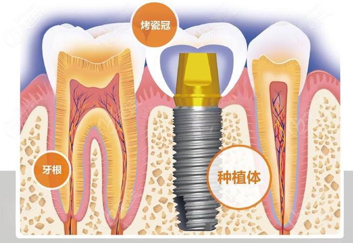 深圳赤峰种牙费用详解：从预算到效果，给您的实惠指南