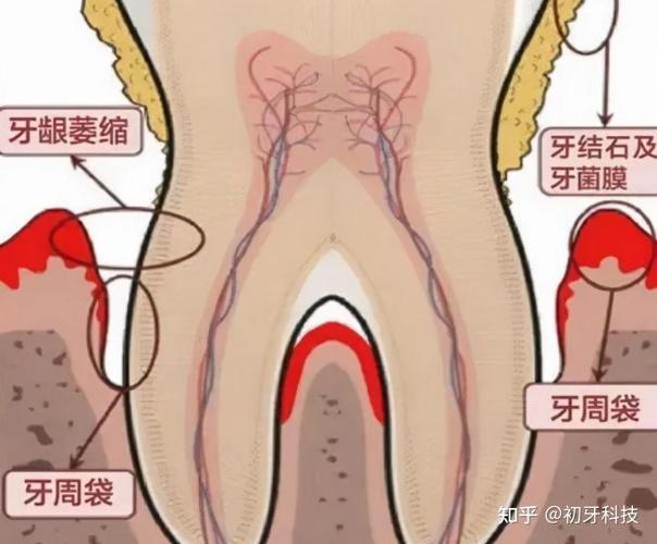 深圳贵阳种植牙2026年单颗3500到5500元贵吗