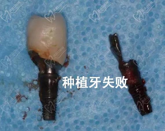深圳种植牙失败了怎么办？修复费用到底要多少？
