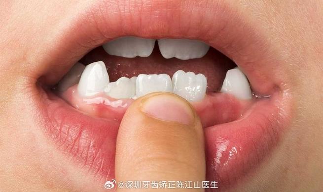 深圳小孩牙齿长成锯齿状,到底严重不严重?