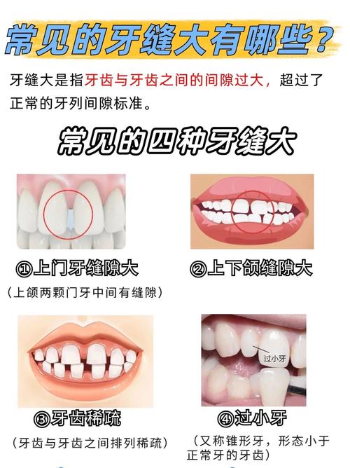 深圳矫正牙齿门牙缝隙变大了?医生告诉你正常吗咋应对