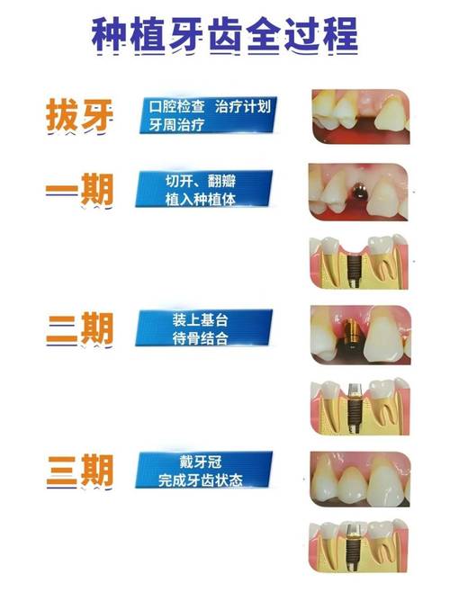 牙齿种植价格一般多少钱一颗_牙齿种植步骤和流程_牙齿怎么种植