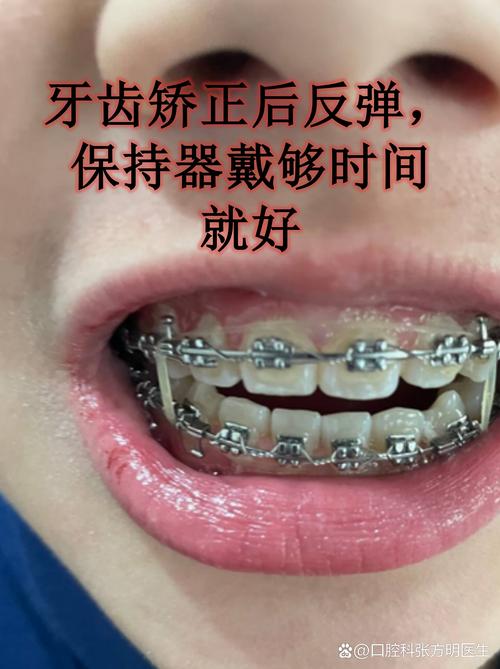 深圳40多岁做牙齿矫正,晚不晚?效果好吗?