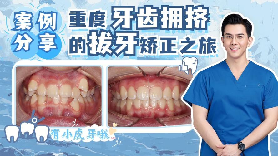 深圳告别“虎牙”尴尬，快速矫正重塑自信笑容
