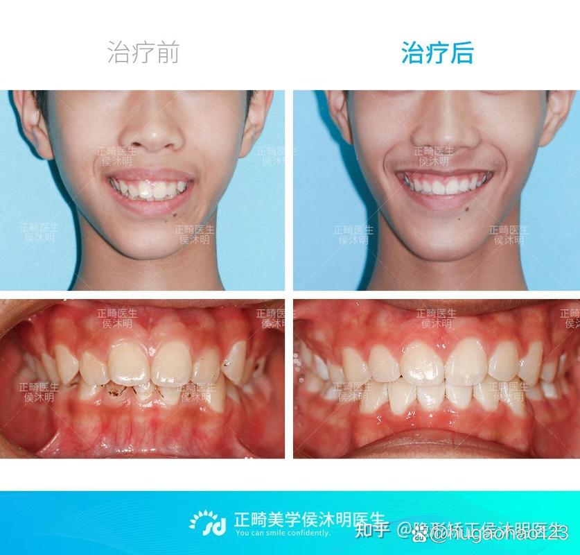 深圳25岁龅牙还能矫正吗？过来人分享真实经历