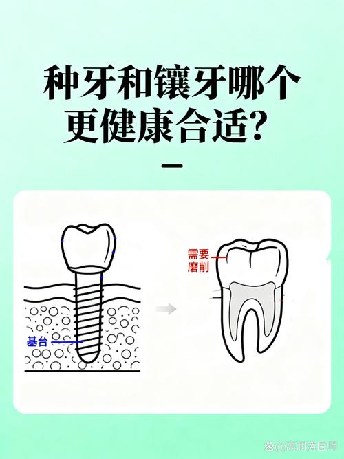 深圳25岁镶牙还是种牙好?别磨坏好牙,年轻人种牙是长期投资
