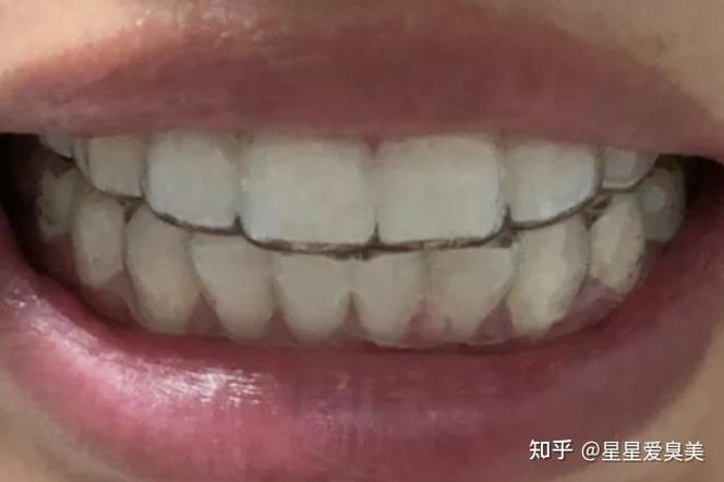深圳牙齿矫正30岁开始晚吗？过来人分享真实经历与经验
