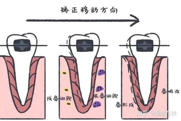 深圳23岁做牙齿矫正晚不晚？过来人分享真实经历