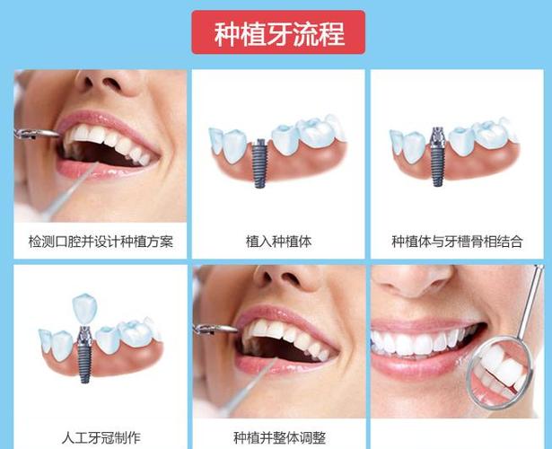 深圳罗湖骨量不足全口种牙多少钱？费用明细来了