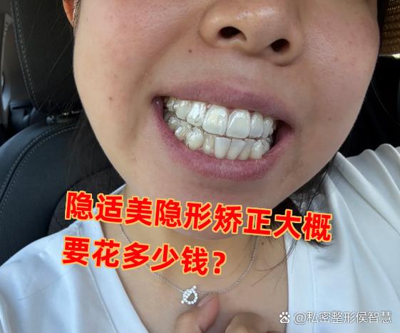 深圳龙岗隐适美牙套收费_深圳隐形矫正牙齿多少钱_深圳隐形牙齿矫正