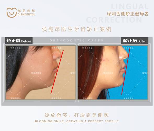 深圳为什么24岁做牙齿矫正效果更好