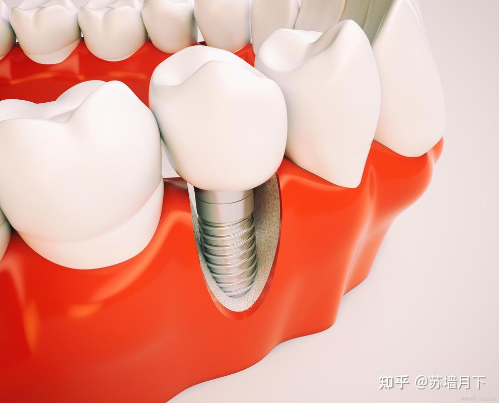 深圳登腾全套餐牙科医院怎么选？种牙经验分享
