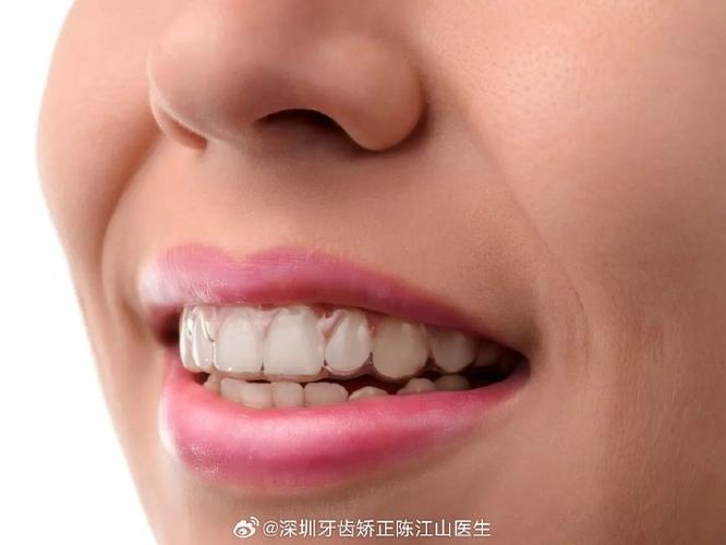 深圳成年人矫正牙齿多久能好?揭秘快速整牙的真相与代价