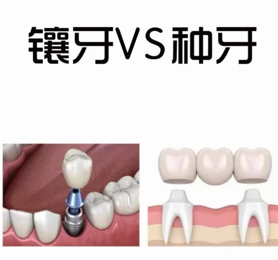 深圳长沙种牙和假牙到底选哪个？看完这篇别再花冤枉钱