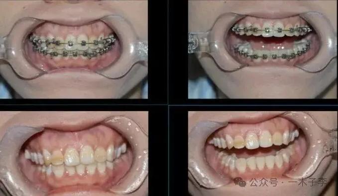 深圳30岁矫正牙齿有什么危害？把坑说透了再决定