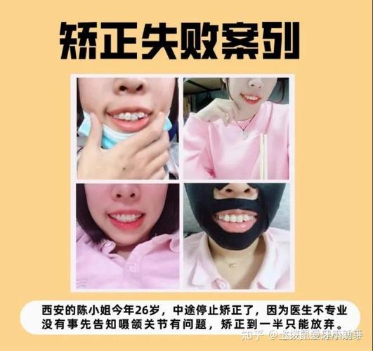 深圳28岁矫正牙齿还来得及吗？我的经历和答案