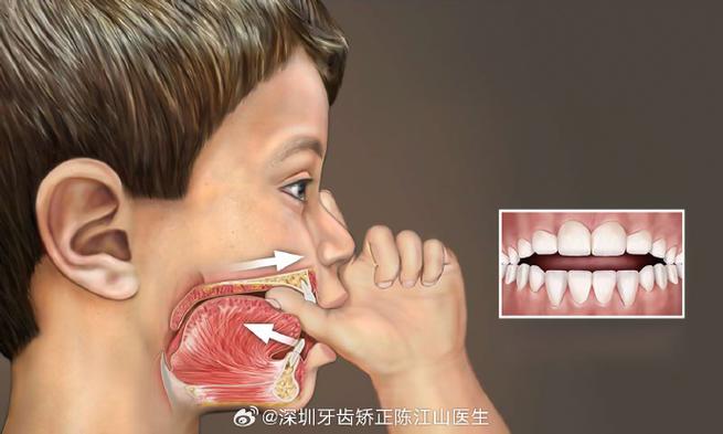 深圳孩子地包天几岁治最好?牙医揭秘黄金期