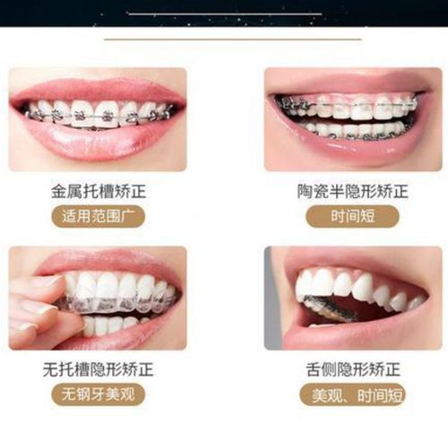 信阳牙齿矫正哪家医院好_信阳市矫正牙齿哪家好_牙齿矫正信阳医院好吗多少钱