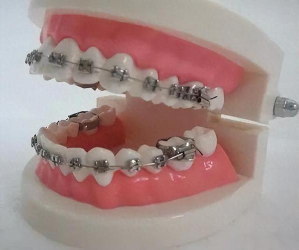 深圳35岁矫正牙齿还来得及吗?真实体验告诉你