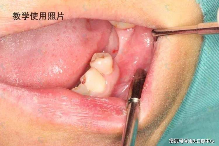 深圳没有牙骨也能种牙？医生说实话