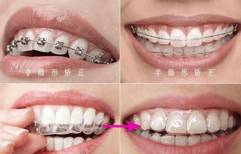 深圳25岁还能矫正牙齿吗?看完这篇不再纠结