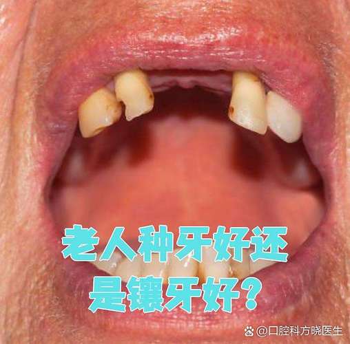 深圳74岁老人种牙晚不晚？医生揭秘高龄种植的真实风险与收益