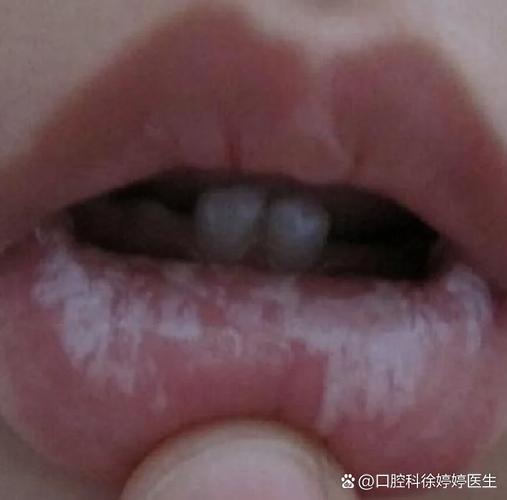 深圳儿童口腔有白色黏膜到底严不严重