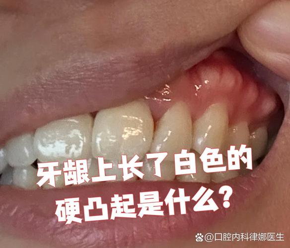 深圳缺一颗牙一定要种吗 不种的后果你承受得起吗