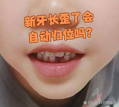深圳六岁孩子门牙长歪先别慌 看这几种矫正办法
