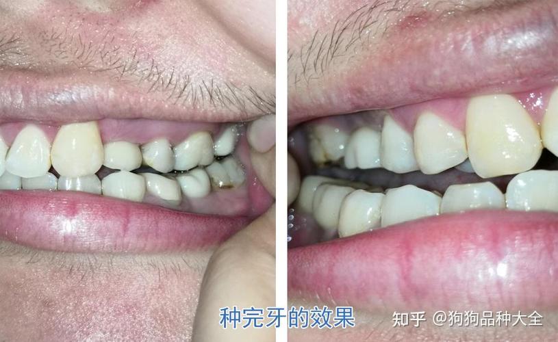 深圳赤峰种植牙哪里好 公立三甲靠谱推荐