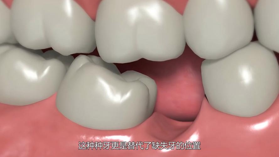 深圳种牙到底疼不疼?一篇说清楚植牙真相