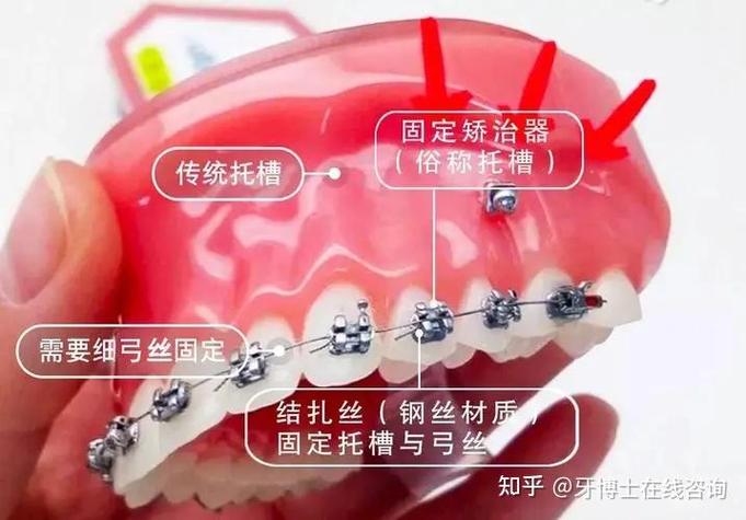 深圳龙岗做隐适美矫正到底要花多少钱?