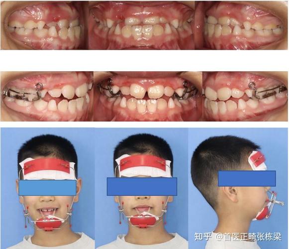 牙齿矫正能走医保吗_牙齿矫正能只矫正上面吗_5岁半了牙齿能矫正吗