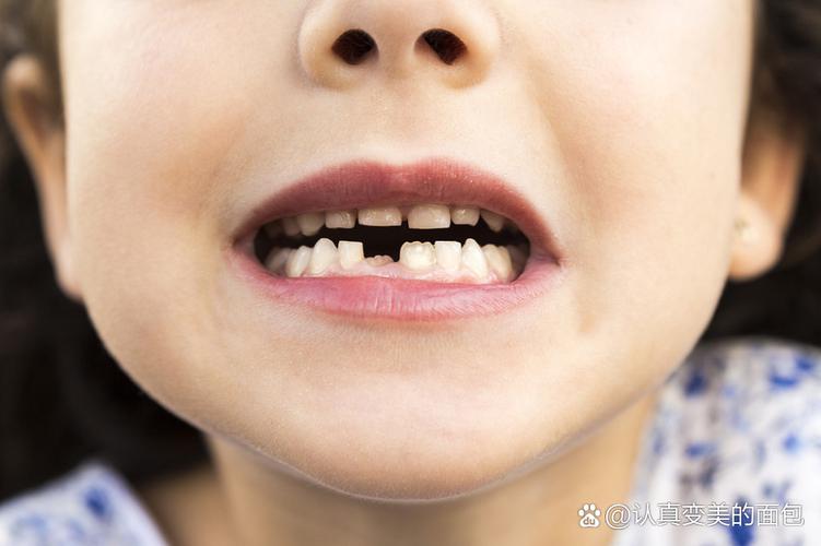 深圳8岁孩子牙齿矫正哪种方法好