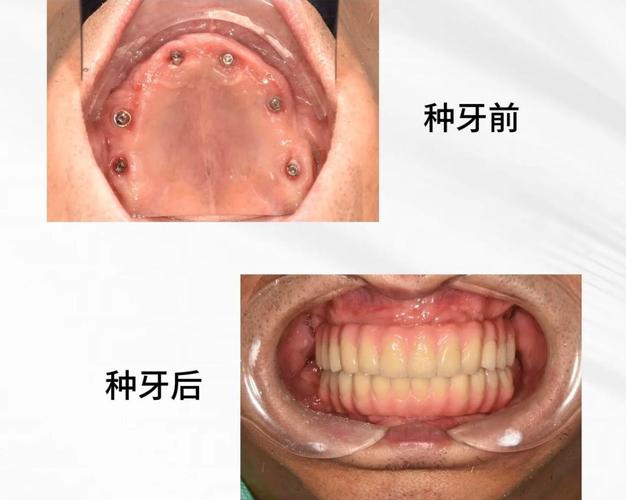 深圳全口种植牙手术到底怎么做