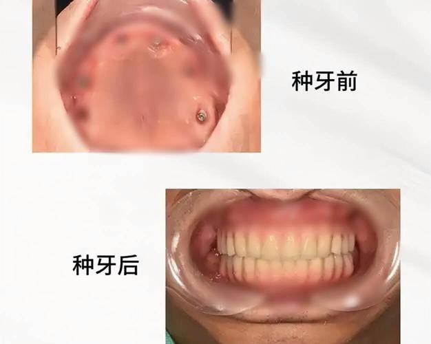 深圳70多岁还能种牙吗?种牙风险大不大?