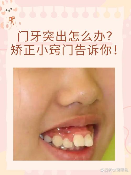 深圳10岁孩子门牙突出，医生揭秘：抓住黄金期，这个最快